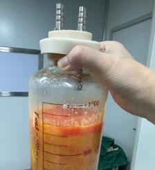 自贡水动力吸脂手术要做多久？